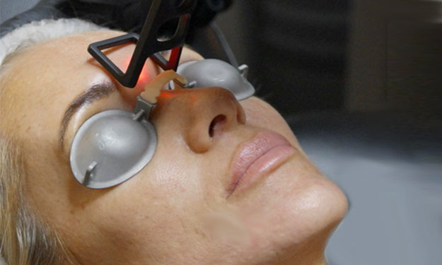 DEKA CO2 Laser