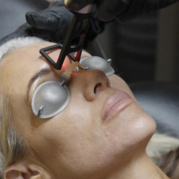 coolpeel antiaging laser